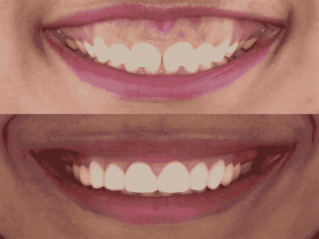 smile makeover in kanchipuram